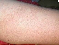 AKA follicular keratosis, lichen pilaris, or chicken skin
